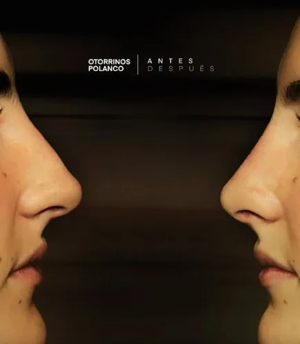Antes y Después Rinoplastia 3