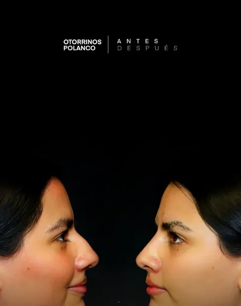 Antes y Después Rinoplastia 5