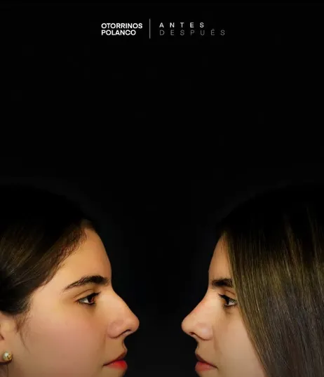 Antes y Después Rinoplastia 6